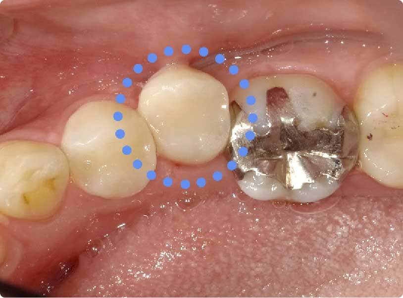虫歯治療後の綺麗な歯