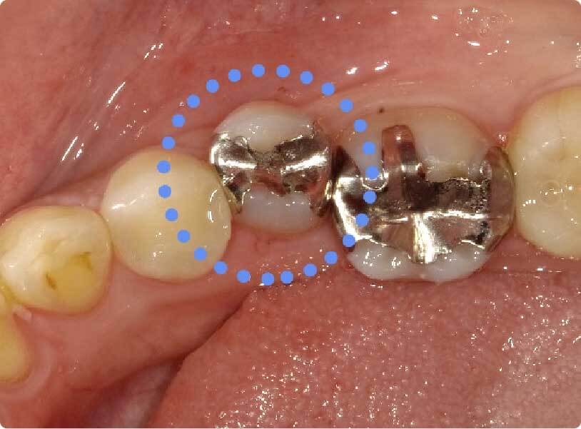 虫歯治療をしている歯の拡大図
